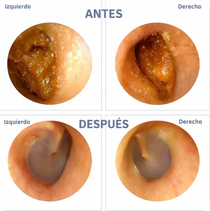 Limpiador De Oídos De Alta Definición