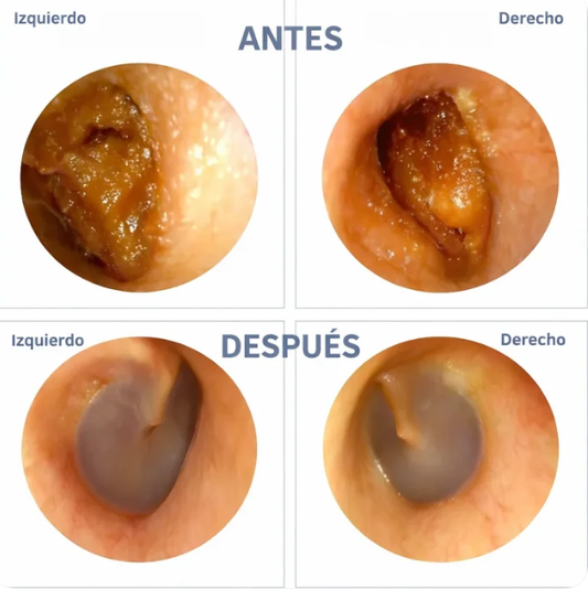 Limpiador De Oídos De Alta Definición